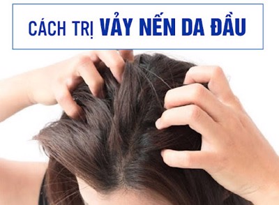 10 cách trị vảy nến da đầu an toàn, hiệu quả nhất